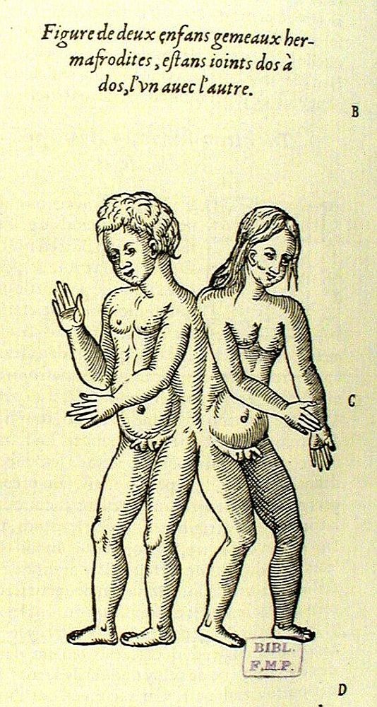 Deux enfans gemeaux hermafrodites, estant ioints dos à dos, SOURCE : http://www.biusante.parisdescartes.fr/histmed/image?21188