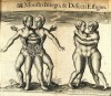 Enfants siamois, SOURCE : http://www.biusante.parisdescartes.fr/histmed/image?21401